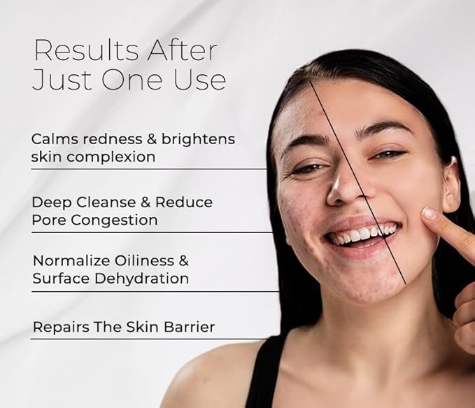 Bioactive Facial Cleanser for Oily Skin, Face Wash Provides a Gentle Deep Clean and Eliminates Excess Oil (4.5 fl oz)