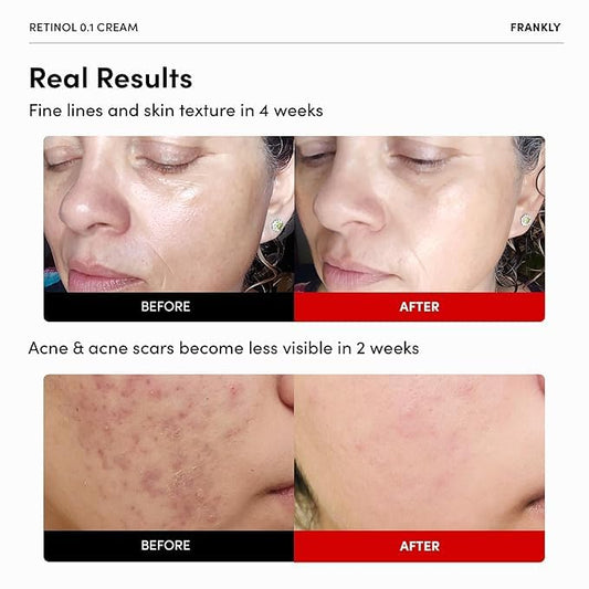 FRANKLY Retinol 0.1% Cream, 1.01 fl oz - Beginner Retinol | Night Cream | with Ceramides & Natural Ginseng | Anti-aging, Wrinkles Care, Reduces Congestion and hyperpigmentation | Korean Skin Care