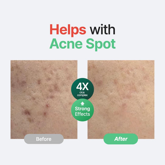 PURITO Centella Unscented Serum, 34,860 ppm Centella, Facial Serum for Sensitive Skin & Acne-Prone Skin, Soothing Serum, Vegan & Cruelty-Free, Korean Skincare, 2 fl.oz / 60ml