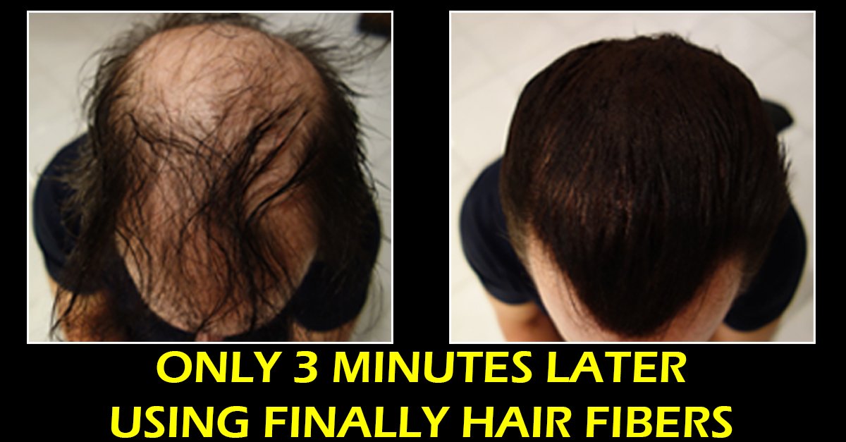 Hair Building Fibers White (Pure White) 28g Bottle of Finally Hair Loss Concealer Fibers and Finally Hair 120ml 4.1 Oz. Bottle of Fiber Lock Hair Building Fiber Spray (Pure White (Snow White))