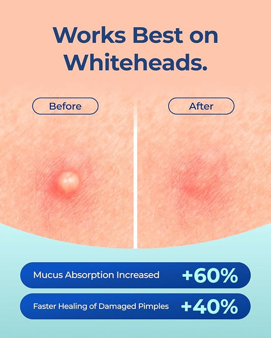 Pimple Patches for Face Acne: Invisible 0.1mm Ultra-Thin Hydrocolloid Zit Stickers with Tea Tree Oil - 308 Dots, 2 Sizes (Whiteheads/Sensitive Skin)