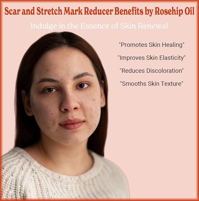 SALE! 4oz Rosehip Seed Oil, 100% Pure and Natural, Cold-Pressed, Unrefined, Organic Moisturizer for Skin and Hair - Includes Pump & Dropper