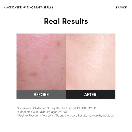 FRANKLY Niacinamide 15% & Zinc Beads Serum: Acne & Dark Spots Care, Oil Control, Even Skin Texture & Glow | Vegan & Cruelty-Free | Non-Comedogenic All skin types Korean Skincare | 1.01 fl.oz