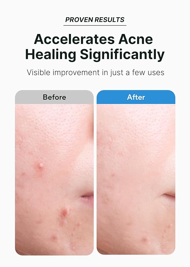 EasyDerm Relief Invisible Patch(42 counts) 10,000ppm of Tea Tree Oil and 2-in-1 Pimple Popper Tool