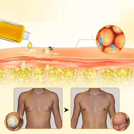 ThermoFirm Bee Venom Gynecomastia Oil, 2025 New Chest Muscles Bee Venom Oil,Strengthen The Chest Muscles (2 Bottle)