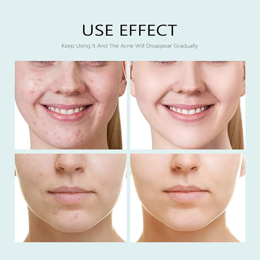 Facial Mask Anti Acne Face Masks Skin Care, Sheet Masks With Salicylic Acid Sheet For Acne Prone Hydrating Moisturizing Skincare for Scar Breakouts Pimple Beauty Oil Control Redness 10 Sheets