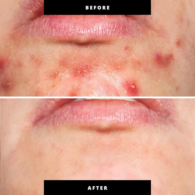 Red & Blue Light Therapy for Face and Neck, Beauty Wand with Dual Light and Infared Modes