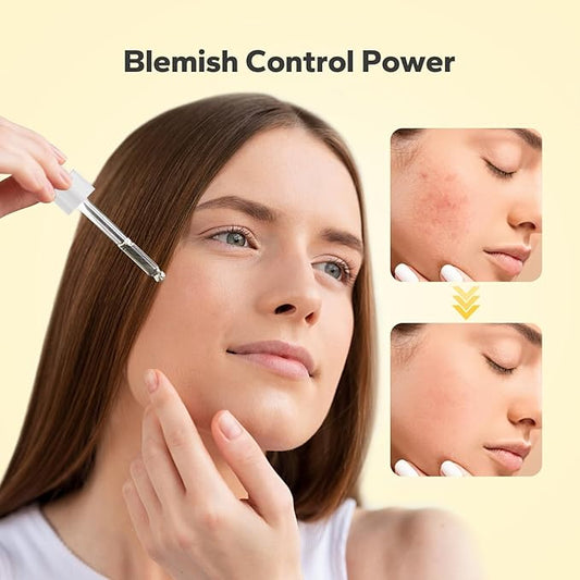 10% Azelaic Acid Serum (1 Fl Oz), Niacinamide Infused Skin Care for Face, Pore Minimizing, Redness Relief, Reduce Cystic Acne Scar, Blemish Control Serum