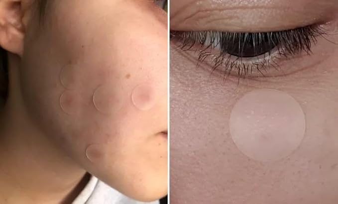 Hydrocolloid Acne Patch with Salicylic Acid to safely heal pimples fast. 72 patches in 2 sizes.