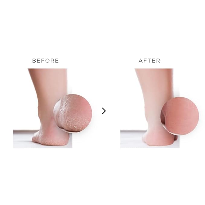 How to Get Soft Feet | Foot Care Kit Includes 120ml Instant Foot Peel Spray for Calluses Removal, Softening Balm & File | Professional Products to Make Your Feet Soft