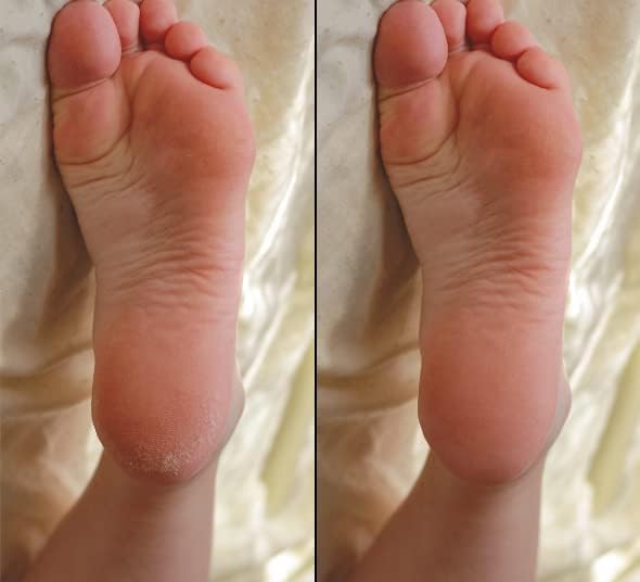 How to Get Soft Feet | Foot Care Kit Includes 120ml Instant Foot Peel Spray for Calluses Removal, Softening Balm & File | Professional Products to Make Your Feet Soft