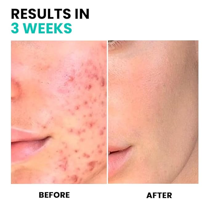 Conatural Niacinamide Serum 30ml 10% + Zinc 1% - Anti-Aging Skin Serum & Pore Minimizer, Vitamin Serum for Skin, Glowing Complexion, Effective Solution for Open Pores & Large Pores Reduction