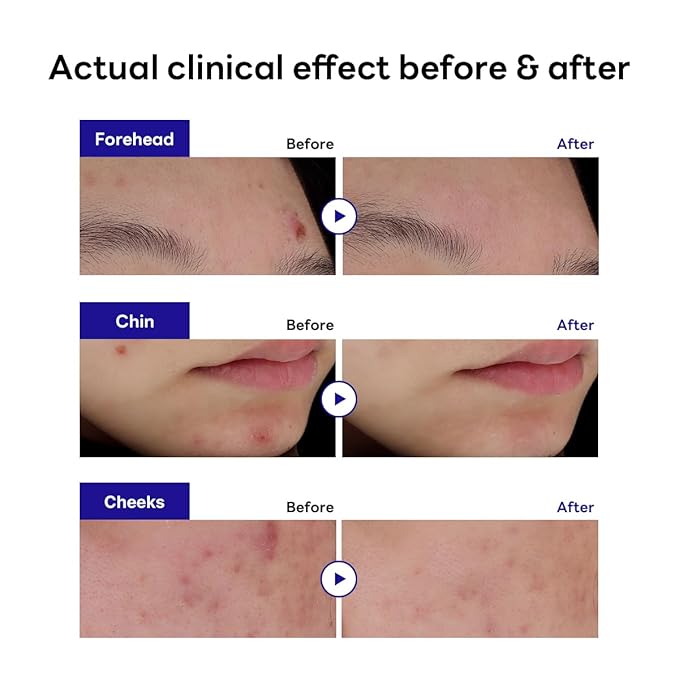 MEDIHEAL Derma Clear Madecassoside Blemish Patch (44 Counts) - Acne Spot Protection, Fast Healing with Madecassoside & Niacinamide