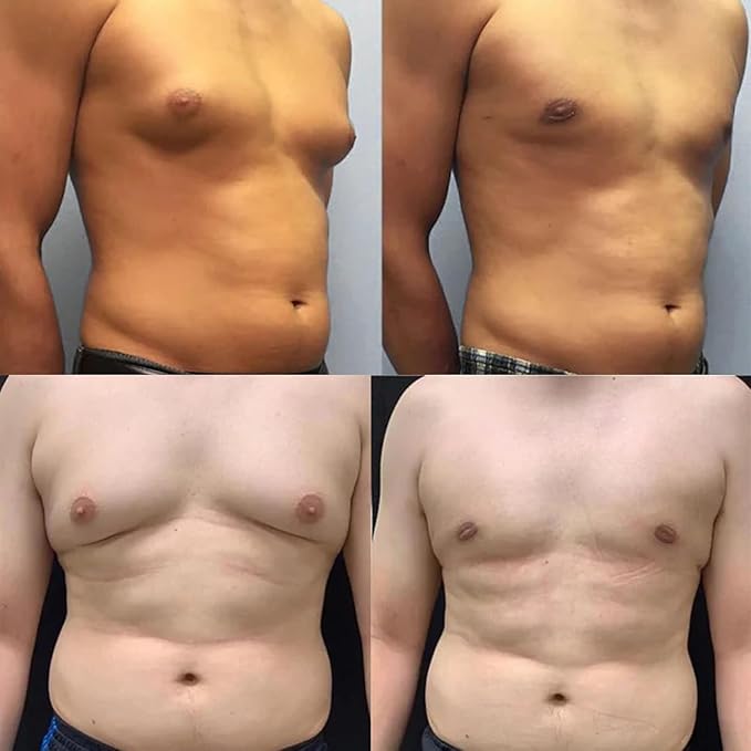 ThermoFirm Bee Venom Gynecomastia Oil, 2025 New Chest Muscles Bee Venom Oil,Strengthen The Chest Muscles (2 Bottle)