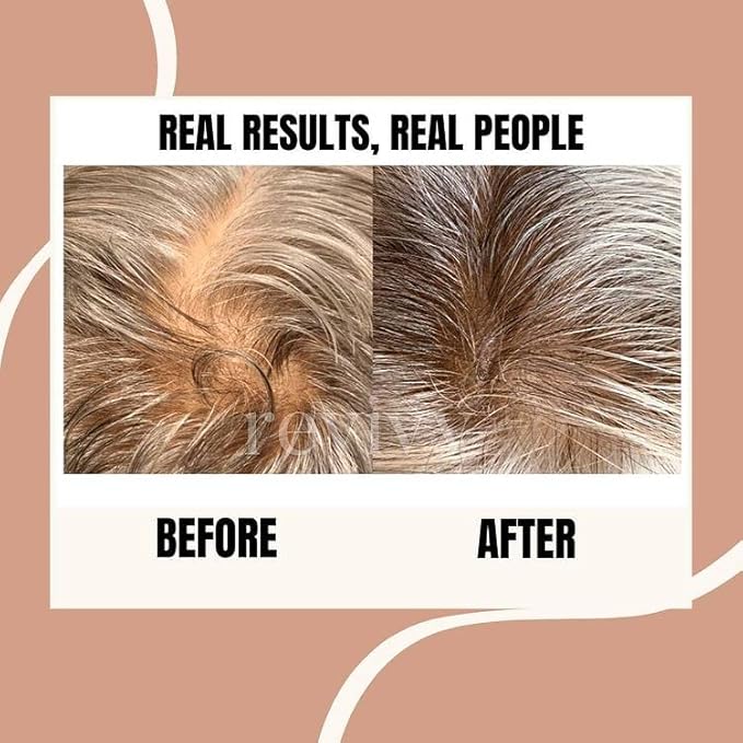 REVIVV® Roller for Hair Rejuvenation – 0.25mm Roller for Scalp, Hair, Beard, Skin – 45 Day Supply