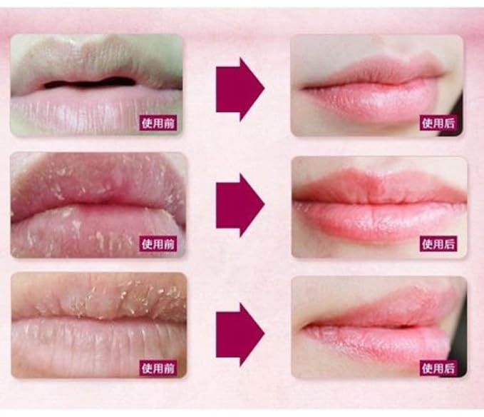 5 Masks 24K Gold Collagen Lip Treatment Mask Patches. Plumper Fuller Softer Lips. Anti Aging Reduce Fine Line Wrinkles Creases Hydrating Moisturizing Uplifting Tone Firmer Smooth Lips Regeneration.