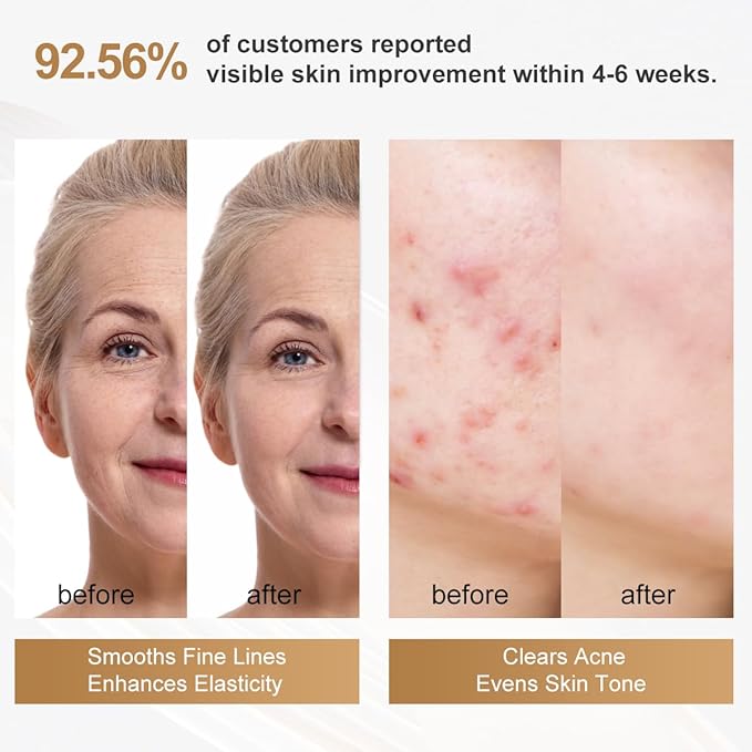 FDA cleared LED Facial Skin Care Mask -Blue & Red Light Treatment Photon Mask (Pearl)