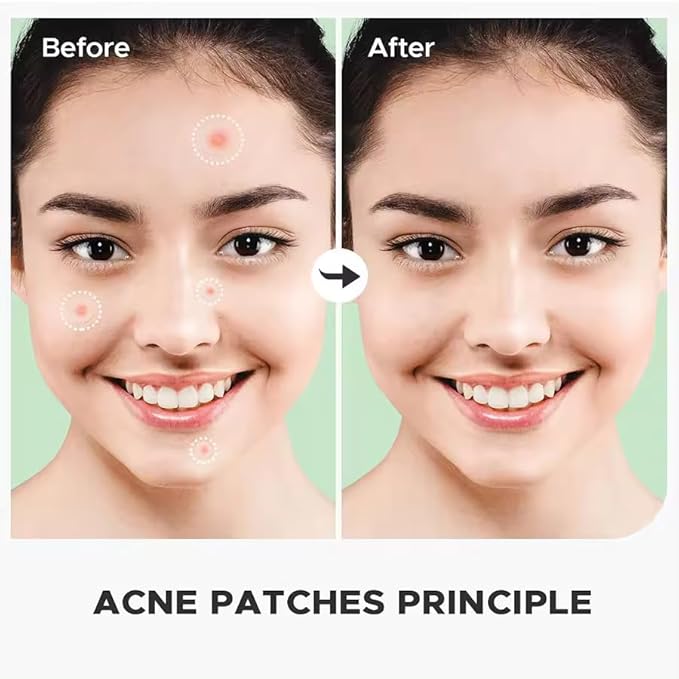 Acne Patches for Face, Acne Patches for Blemishes and Zits (36pcs)(One Sheet), Black