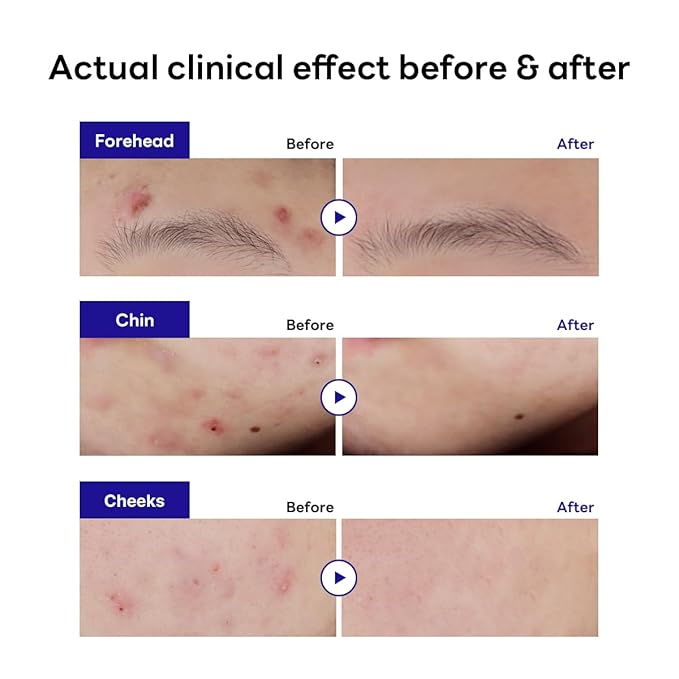 Mediheal Derma Clear Teatree Treatment Spot Patch (44 Counts) - Acne Relief, Oil and Moisture Balance with Teatree & Salicylic Acid