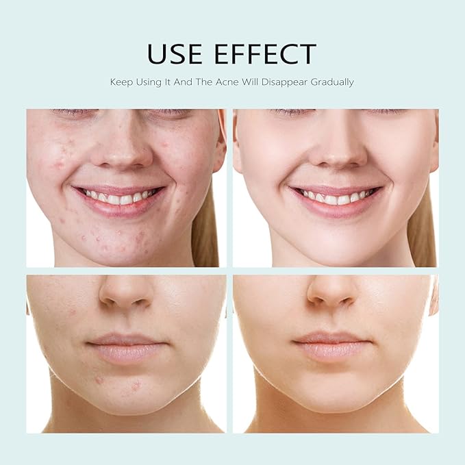 Facial Mask Anti Acne Face Masks Skin Care, Sheet Masks With Salicylic Acid Sheet For Acne Prone Hydrating Moisturizing Skincare for Scar Breakouts Pimple Beauty Oil Control Redness 10 Sheets