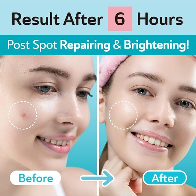 Ultra Invisible Acne Patches Pimple Patches Hydrocolloid Acne Patches Zit Patches Hydrocolloid Bandages Acne Spot Treatment - Day & Night Use 48 Pieces 2 Sizes