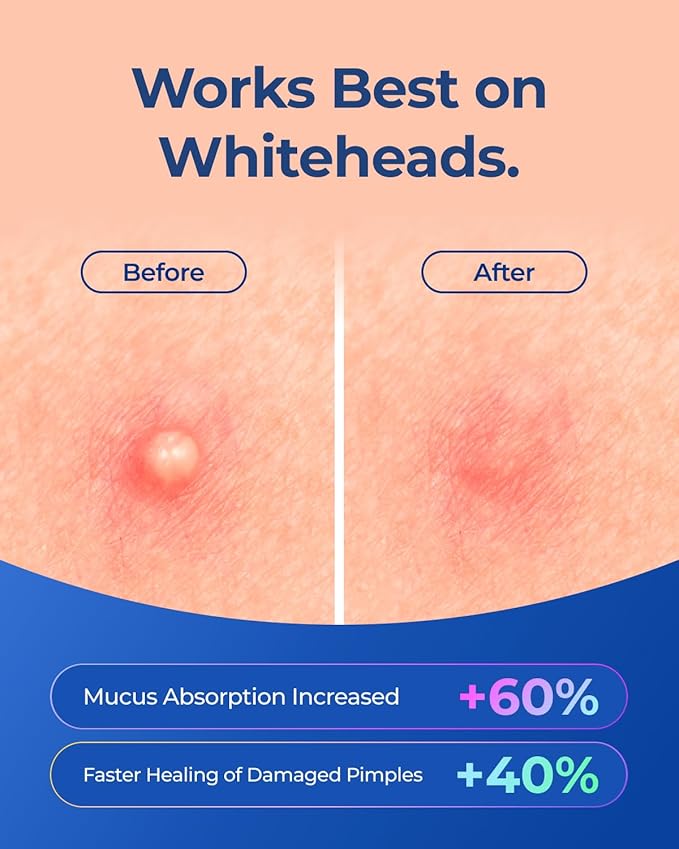 Star Pimple Patches for Face: Cute Acne Dots Hydrocolloid Stickers, Strong Absorption, 6 Colors, 312 Patches, Overnight Care