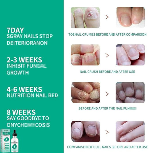 Kerassentials Toenail Oil, Kerassentials Nails Nutrient Oil, Nail Repair Solution 30ML/1PCS (4PCS)