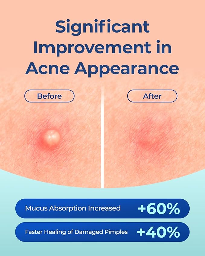 Pimple Patches for Face Acne: Invisible 0.1mm Ultra-Thin Hydrocolloid Zit Stickers with Tea Tree Oil - 44 Dots, 2 Sizes (Whiteheads/Sensitive Skin)