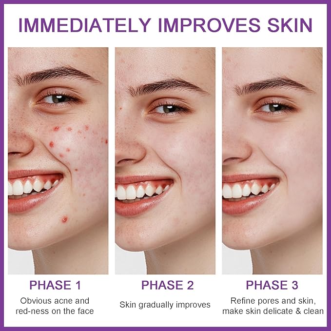 Azelaic Acid Serum 12% Azelaic Acid Cream, Azelaic Acid Facial Cream, Facial Serum with Hyaluronic Acid and Niacinamide, Redness Reducing Skin Care, Balances Excess Sebum