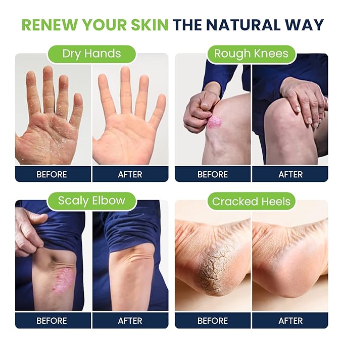 Citrus Detox Foot Soak with Epsom Salts - for Foot Callus, Tea Tree Oil Foot Cream - Moisturizing Athletes Foot Care For Dry Cracked Feet Cream - Heel & Callus Removal