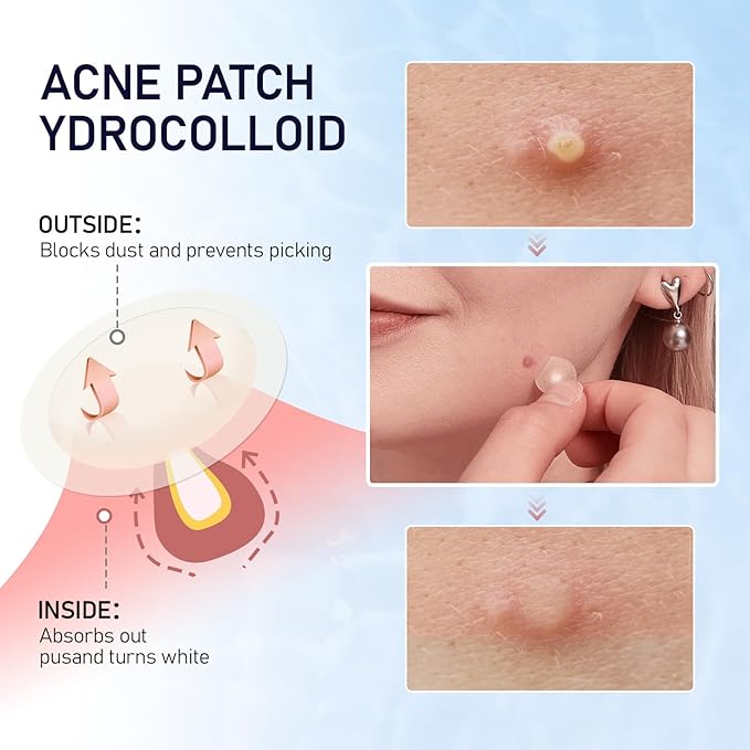 Pimple Patches for Face, 3 Sizes 288 Counts Acne Patches, Hydrocolloid Patches Zit Patches for Skin Care, Blemish Patches Invisible Acne Spot Treatment with Salicylic Acid, Tea Tree Oil