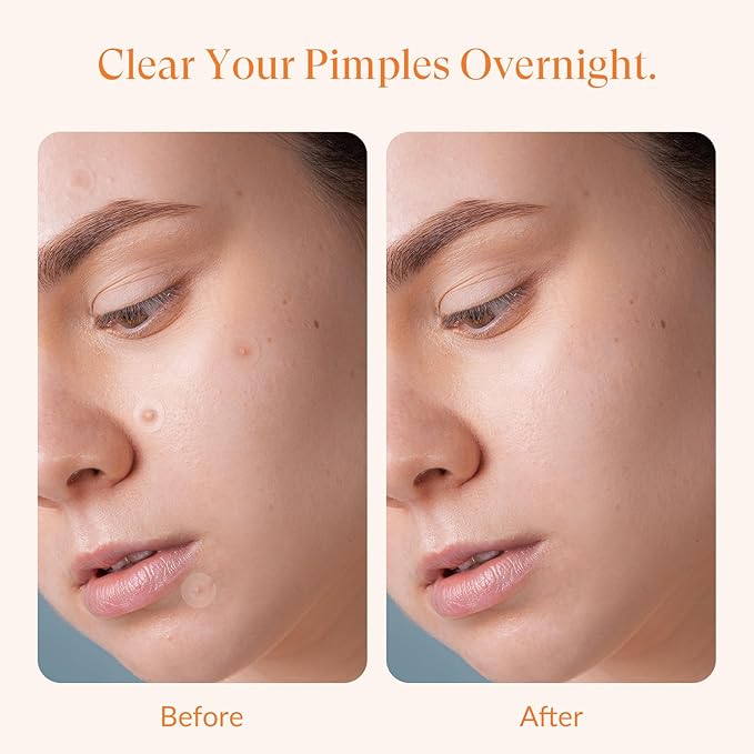 RPELife Hydrocolloid Pimple Patches with Salicylic Acid for Face, Pimple Patch Invisible Spot Cover Treatment for Zits, Blemishes, and Pimples – Absorbing Zit Patch for Clear Skin (144 Count）