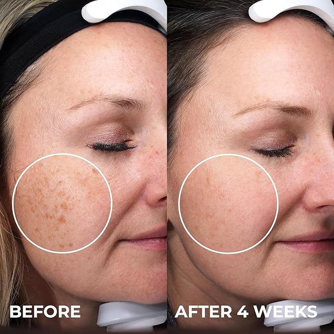 ABERA Skin Renewing Serum For Melasma Treatment, High-Potency Saffron Extract + Gift Curcumin Face Cleanser with Turmeric, Face Wash to Reduce Sebum (3 Boxes + Gift)