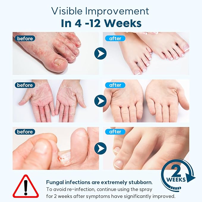 Athletes Foot Treatment, Natural Herbal Athletes Foot Spray for Most Athlete's Foot and Treat Symptoms of Molting, Blisters, Itching and Odor. (1Pc, Fresh)