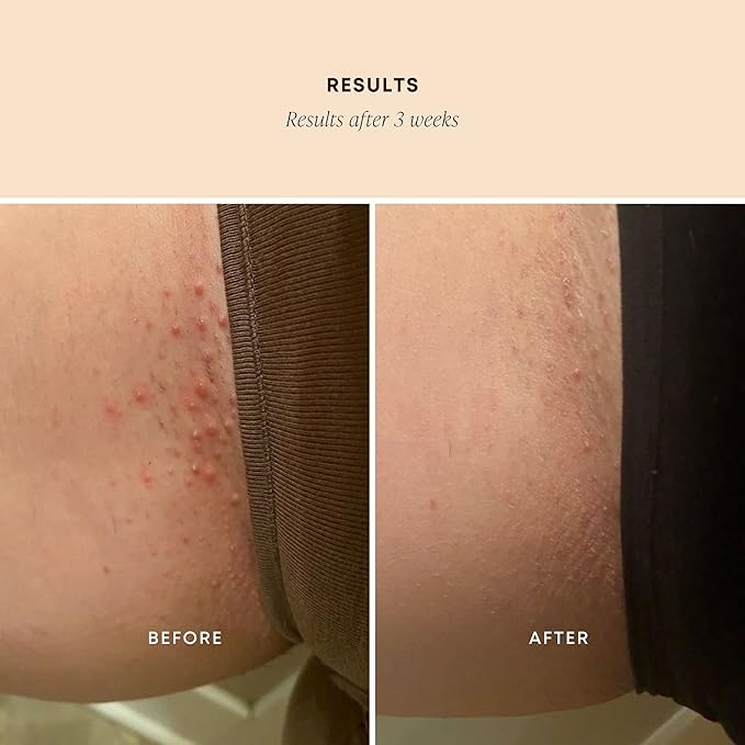 Bushbalm Ingrown Hair Exfoliating Scrub - Reduces Appearance of Ingrown Hairs and Helps with Underarm Bumps - Soothes Razor Bumps, Post Shave Redness and Itching - Sweet Escape 236 ml