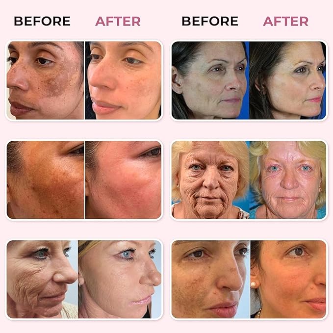 ABERA Skin Renewing Serum For Melasma Treatment, High-Potency Saffron Extract + Gift Curcumin Face Cleanser with Turmeric, Face Wash to Reduce Sebum (3 Boxes + Gift)