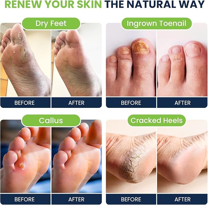 Tea Tree Oil & Citrus Detox Foot Soak with Epsom Salts & Callus Remover for Feet with Extra Strength Gel & Foot Pumice Stone Set