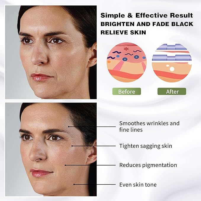 elves Pdo Threads Multi for Face and Whole Body Lift/Multi Threads Pdo with Blunt L Tip/Comes With The Pilot/Starter Tip/ 20pieces (21G50mm)