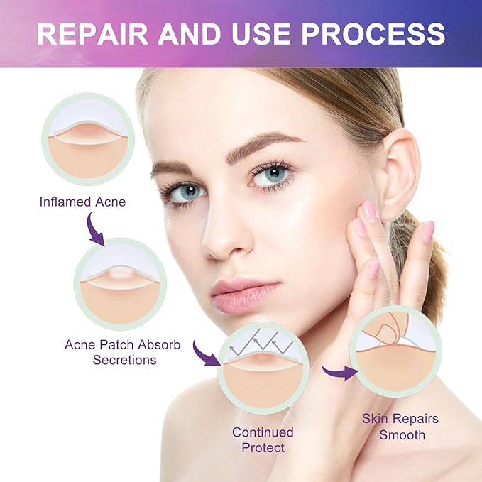 144 PCS Acne Patches Cute Pimple Patches for Face and Skin - Hydrocolloid Acne Treatment Dots to Cover and Reduce Zits, Blemishes, Spots, Star Pimple Patch