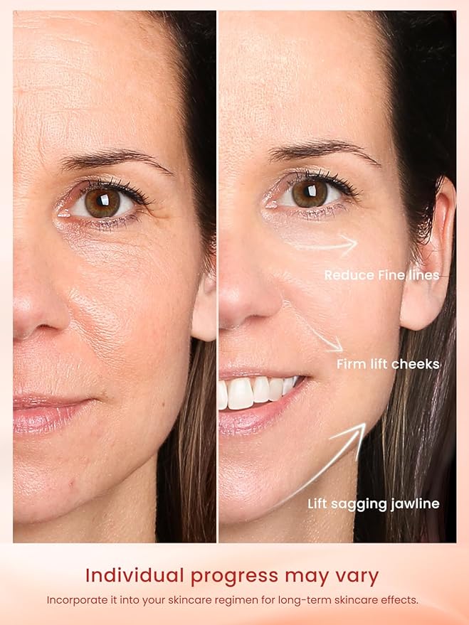 Radio Frequency Skin Tightening Device, Professional Wireless Home RF Skin Tightening Face Machine, Effective Face Wrinkle Removal, Lifting, Firming