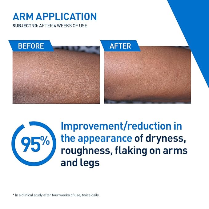 CeraVe Intensive Moisturizing Lotion, Hydro-Urea + Shea Butter, Body Lotion For Dry Skin, Relieves Signs Of Extra Dry Skin, Non Greasy Hydrating Cream For Rough, Tight, Red & Itchy Skin, 16oz