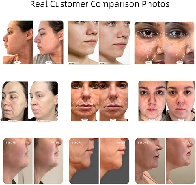 Skin Firming Facial Device, Professional Home Beauty Device for Face and Body, 5 Energy Levels - Salon Results