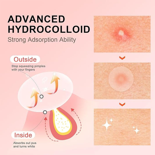 AVJONE Pimple Patches for Face(144 Patches), Hydrocolloid Acne Patches with Tea Tree Oil, pimple stickers for Breakouts, Absorbs Zit, Invisible Spot Cover and Blemish 2 Sizes| Vegan, Cruelty-free