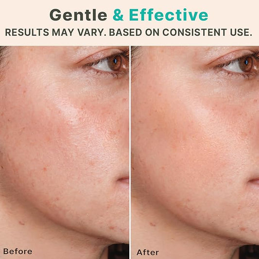 Derma Roller Microneedling Roller - Titanium 0.25mm Micro Needler for Face, Gently Exfoliates, Microneedle Tool for Beard, Scalp & Hair, Skincare Tools for Face