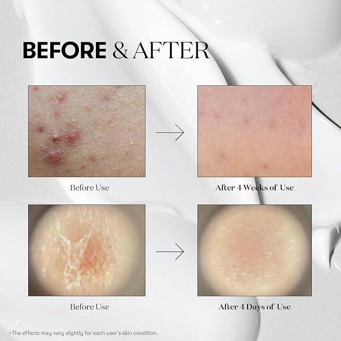 VT COSMETICS CICA Reedle Shot 300, Advanced Night Exosome, Microneedling Serum, Centella Asiatica, Hyaluronic Acid, Propolis, Soft Skin, Regeneration, Glass Skin, Korean Skin Booster 1.69Fl Oz (50ml)