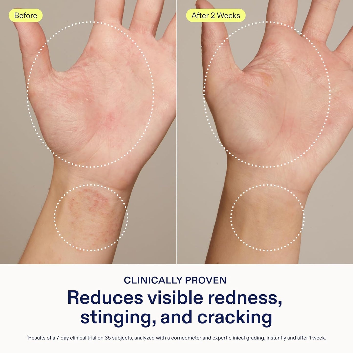 Skinfix Hand Relief Cream - 3 fl oz - Reduces Visible Redness, Stinging & Cracking for Dry, Sensitive Skin - Accepted by the National Eczema Association - Fragrance Free - Vegan, Cruelty Free