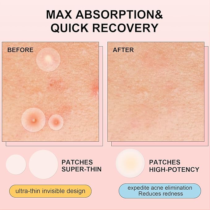 AVJONE Pimple Patches for Face(144 Patches), Hydrocolloid Acne Patches with Tea Tree Oil, pimple stickers for Breakouts, Absorbs Zit, Invisible Spot Cover and Blemish 2 Sizes| Vegan, Cruelty-free