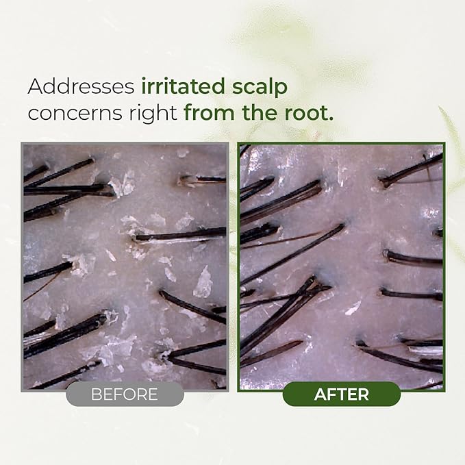 Tea Tree Scalp Treatment | Purifies and Exfoliates Oily Scalp | Natural BHA & Tea Tree | Removes Odor & Buildup | Hypoallergenic Exfoliator, 8.42 fl oz