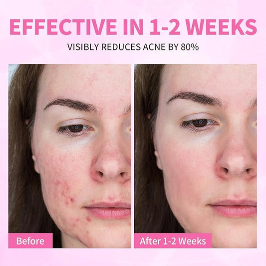 Acne Serum for Face, Back and Body, Gentle Skin Care for Acne Prone Sensitive Skin | For Women & Men