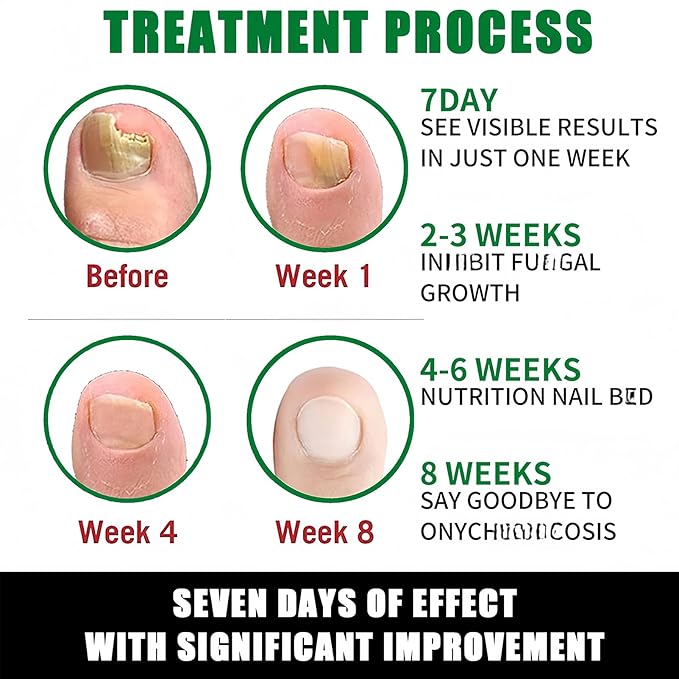 Ginger Nail Treatment-Nail Strengthener for Damaged Nails-Mild Nail Growth Serum for Gingernail & Toenail-Easy to Use, 1Pc 30ML